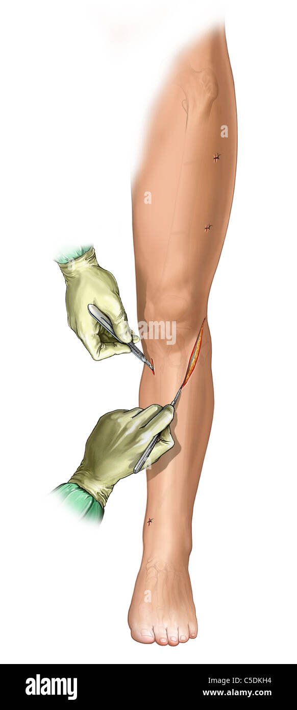Incision on lateral side of the knee to expose tibial plateau fracture. External fixator has been removed. Stock Photo