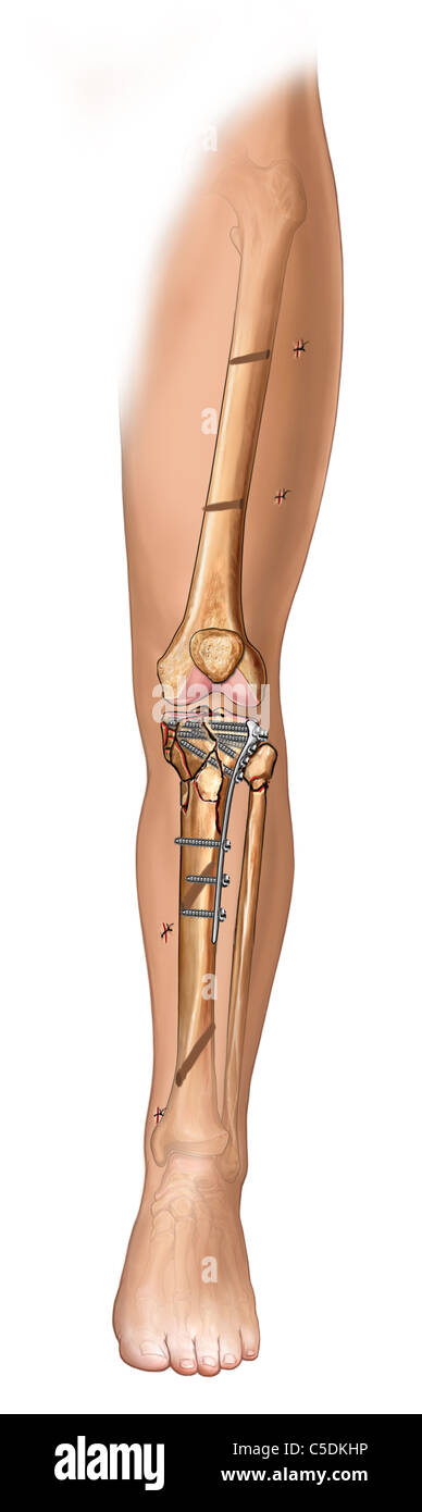 Tibial Fracture Fixation Stock Photos Tibial Fracture