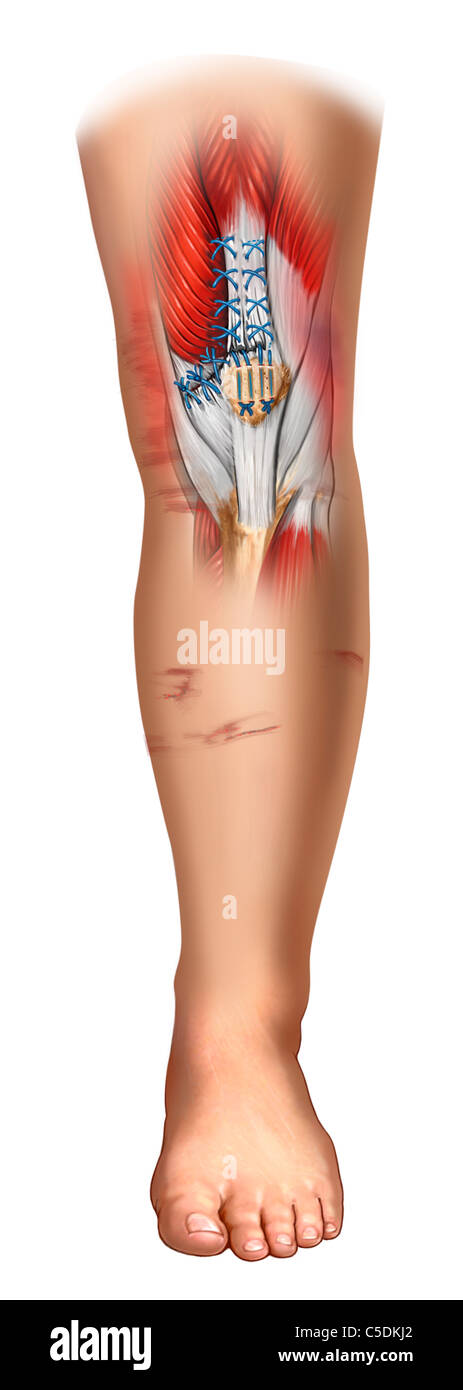 Medial retinaculum and suprapatellar tendon repair Stock Photo