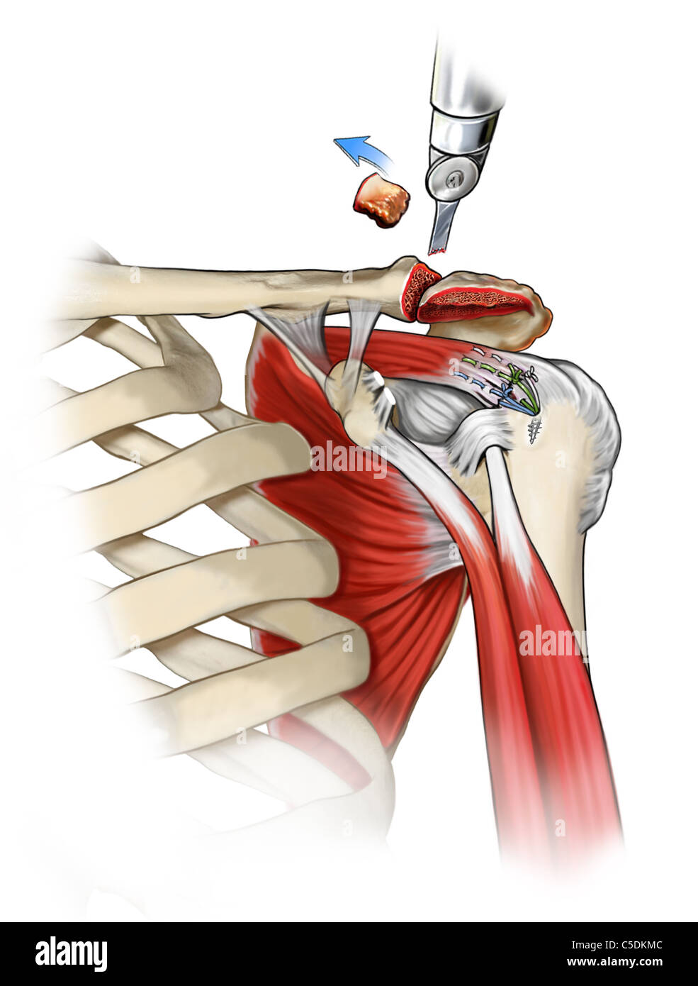 Claviculectomy. Acromioplasty. Rotator cuff tear repair with double suture anchor Stock Photo