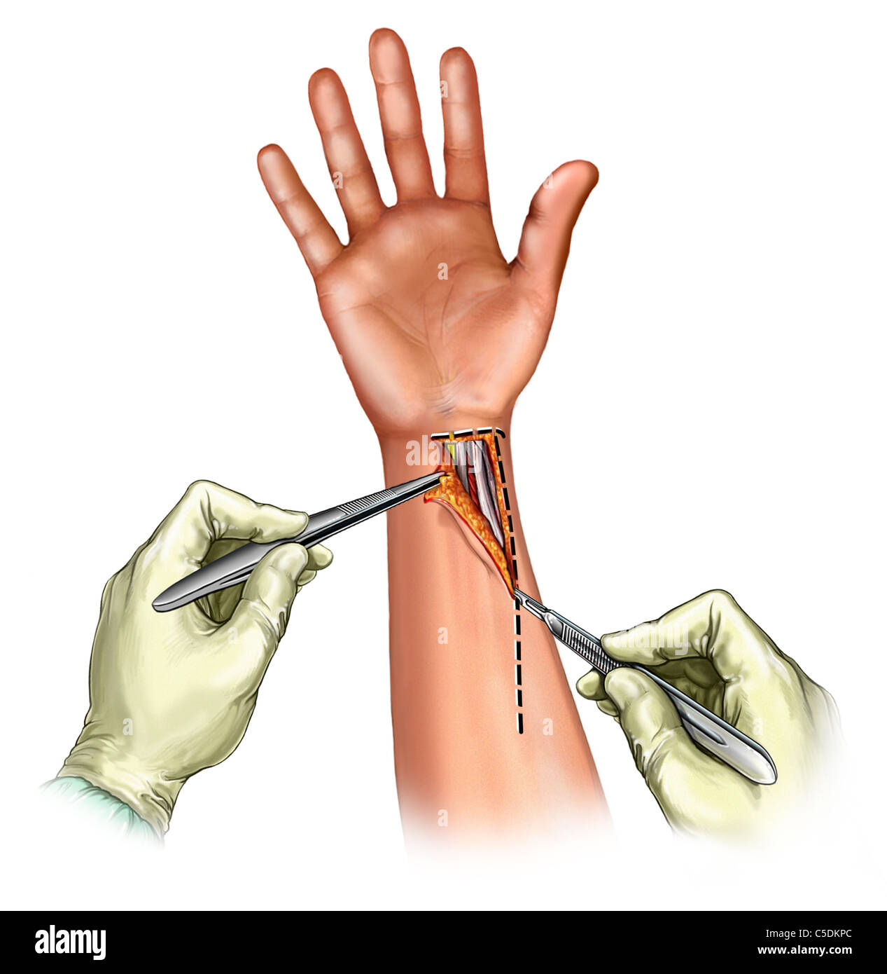Henry's approach incision to expose the distal radius for internal fracture fixation using a volar plate Stock Photo
