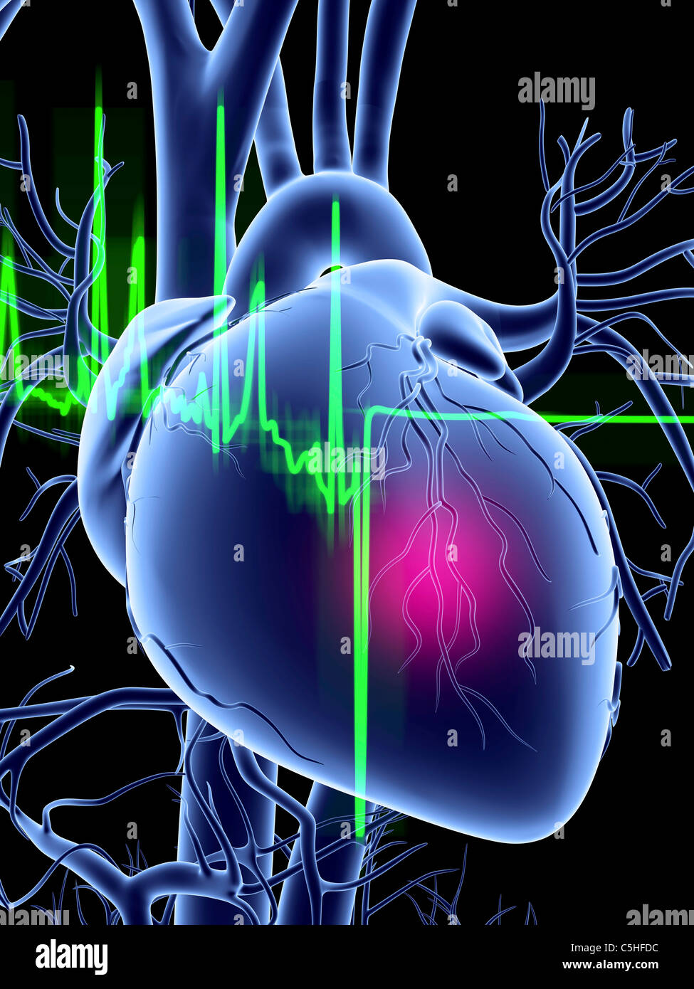 Heart attack and ECG trace Stock Photo
