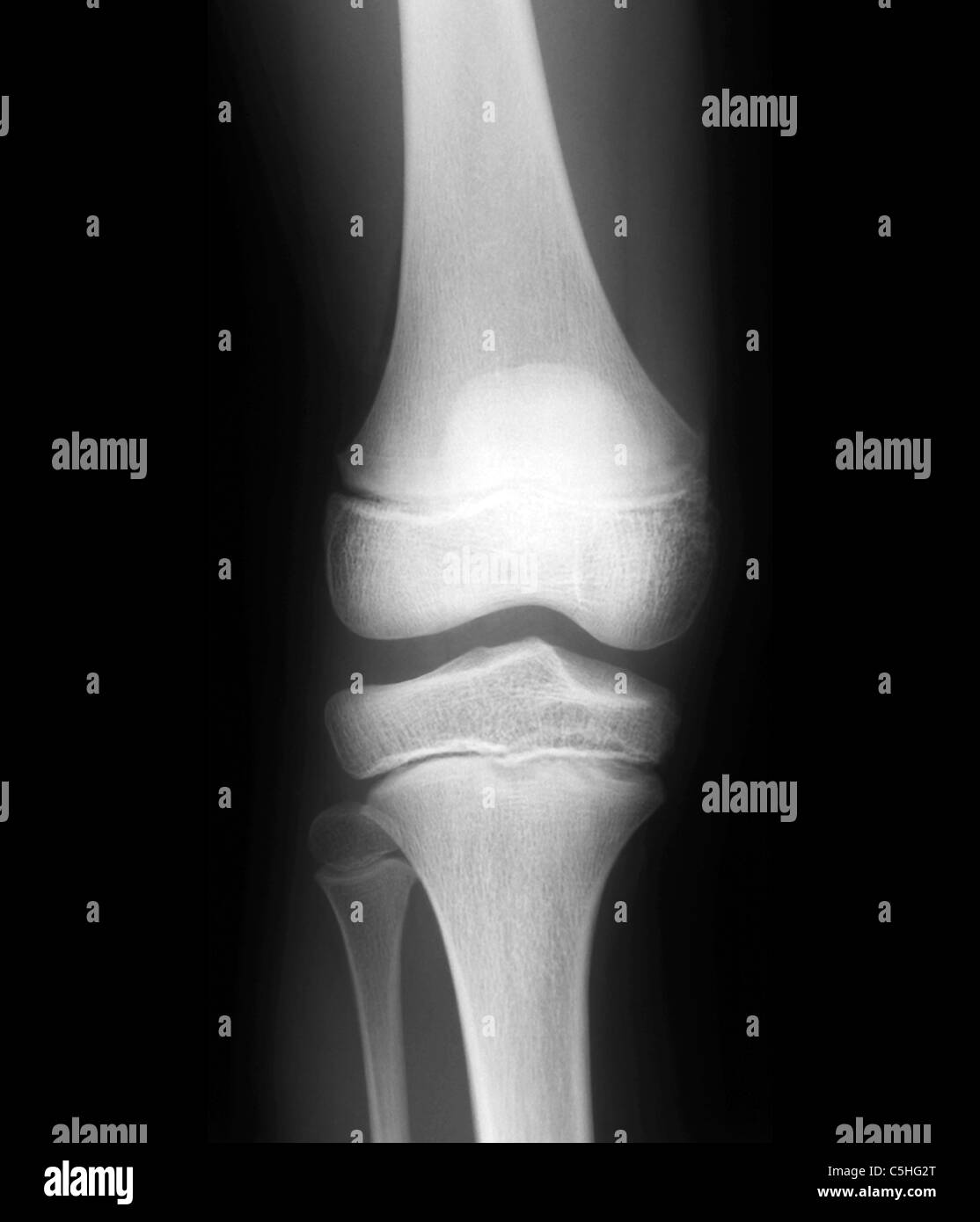 Normal child's knee, X-ray Stock Photo
