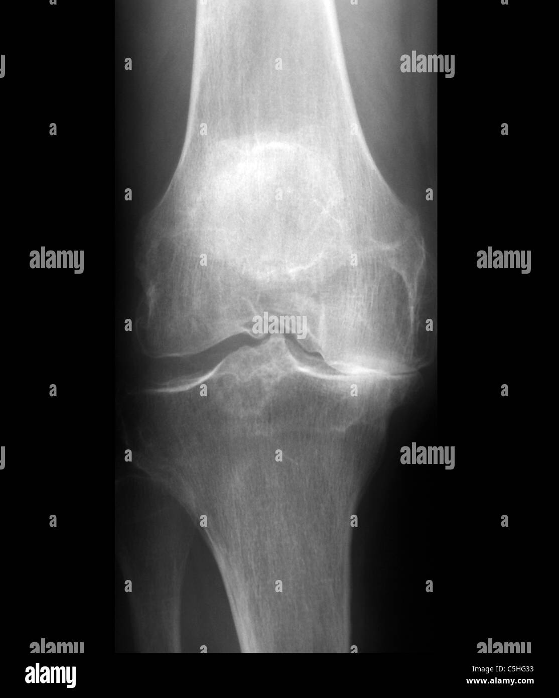 Arthritis of the knee, X-ray Stock Photo