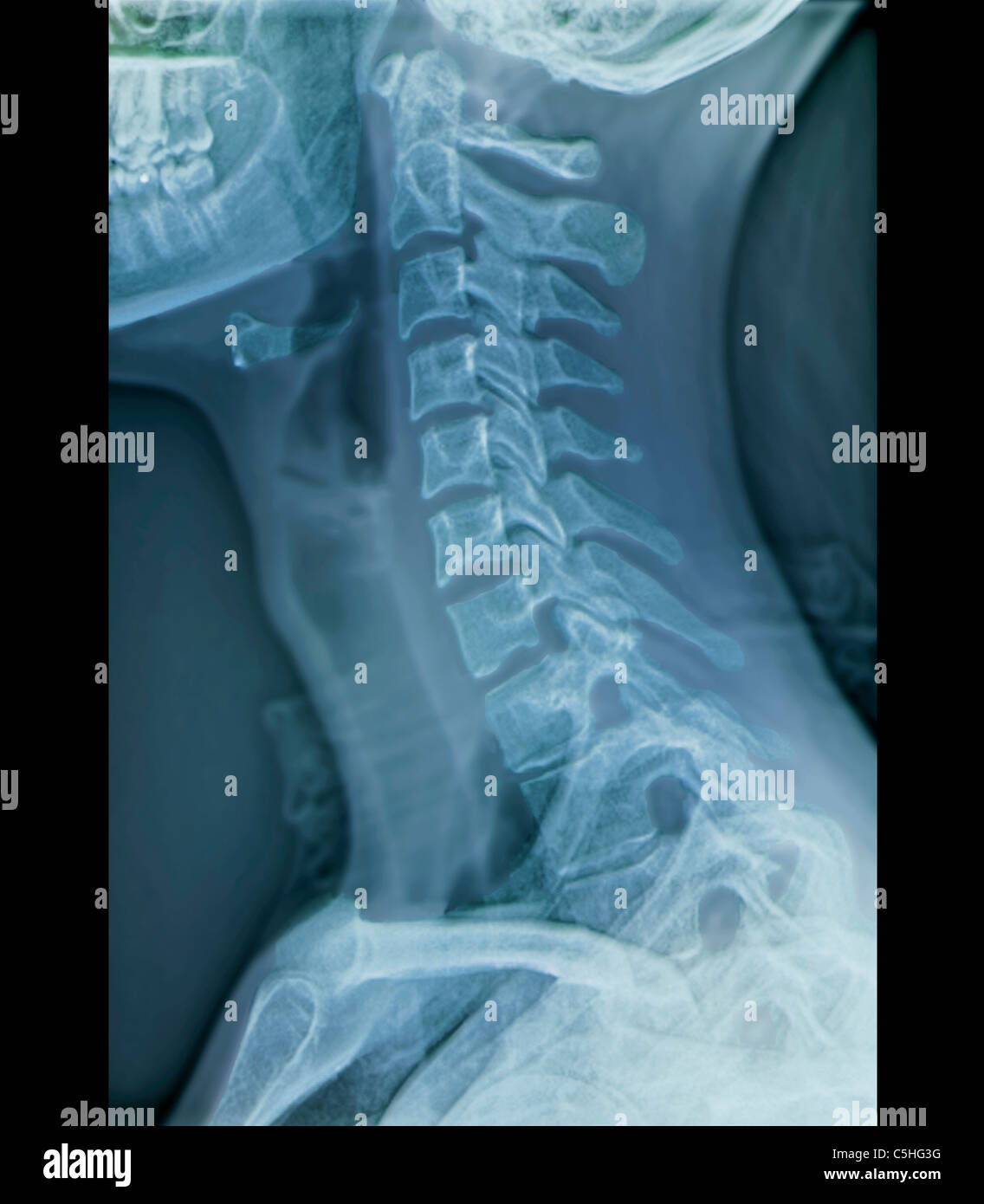 Normal Neck X Ray Side View