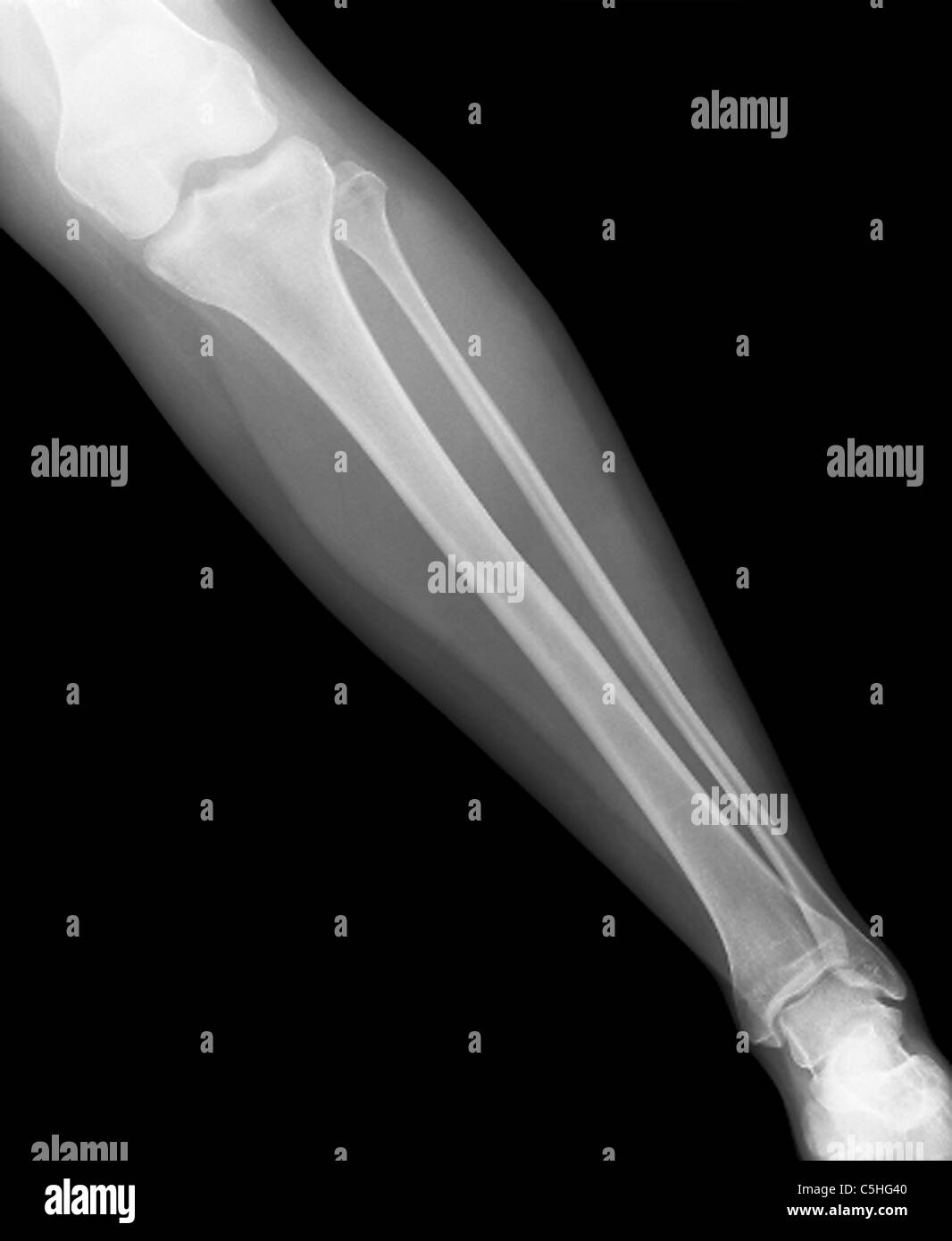 Normal lower leg, X-ray Stock Photo