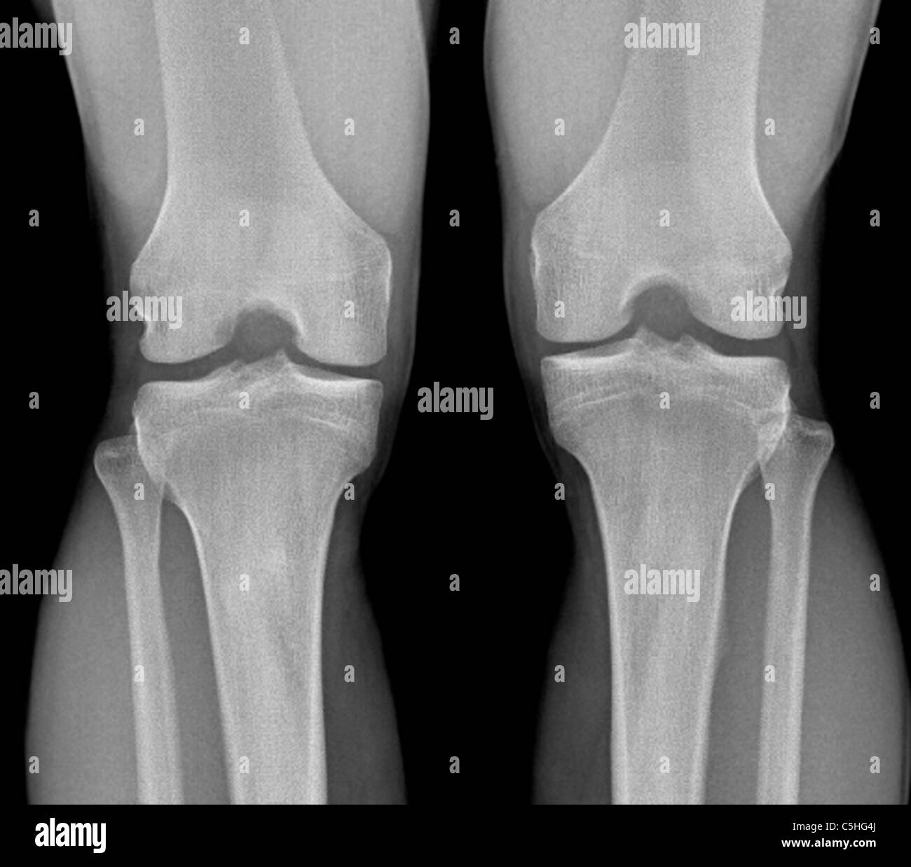 Normal knees, X-ray Stock Photo