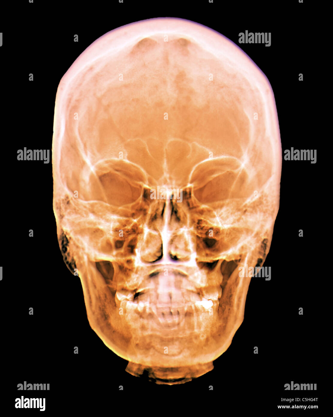 Normal Skull X Ray High Resolution Stock Photography and Images Alamy