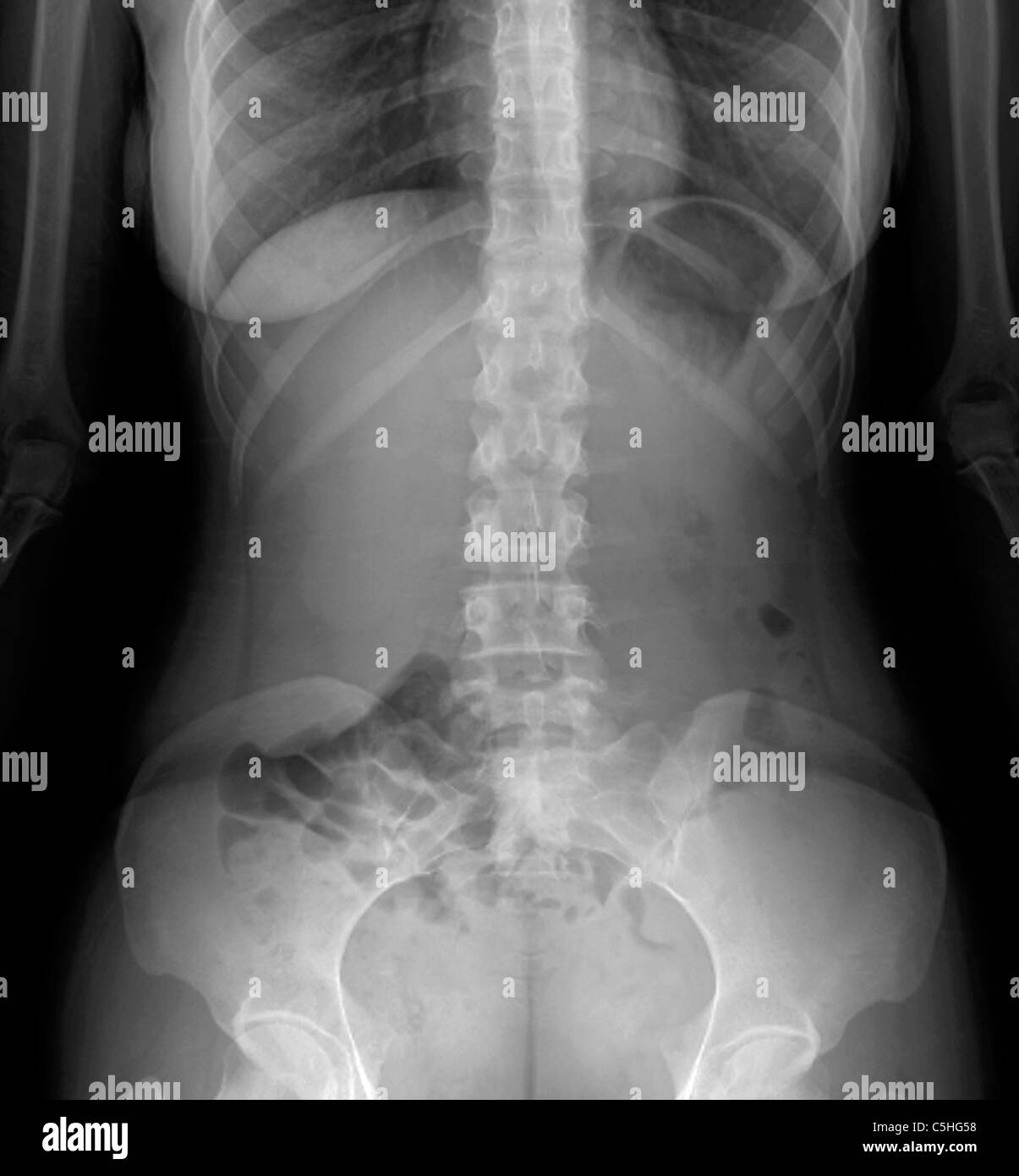 Normal abdomen, Xray Stock Photo Alamy