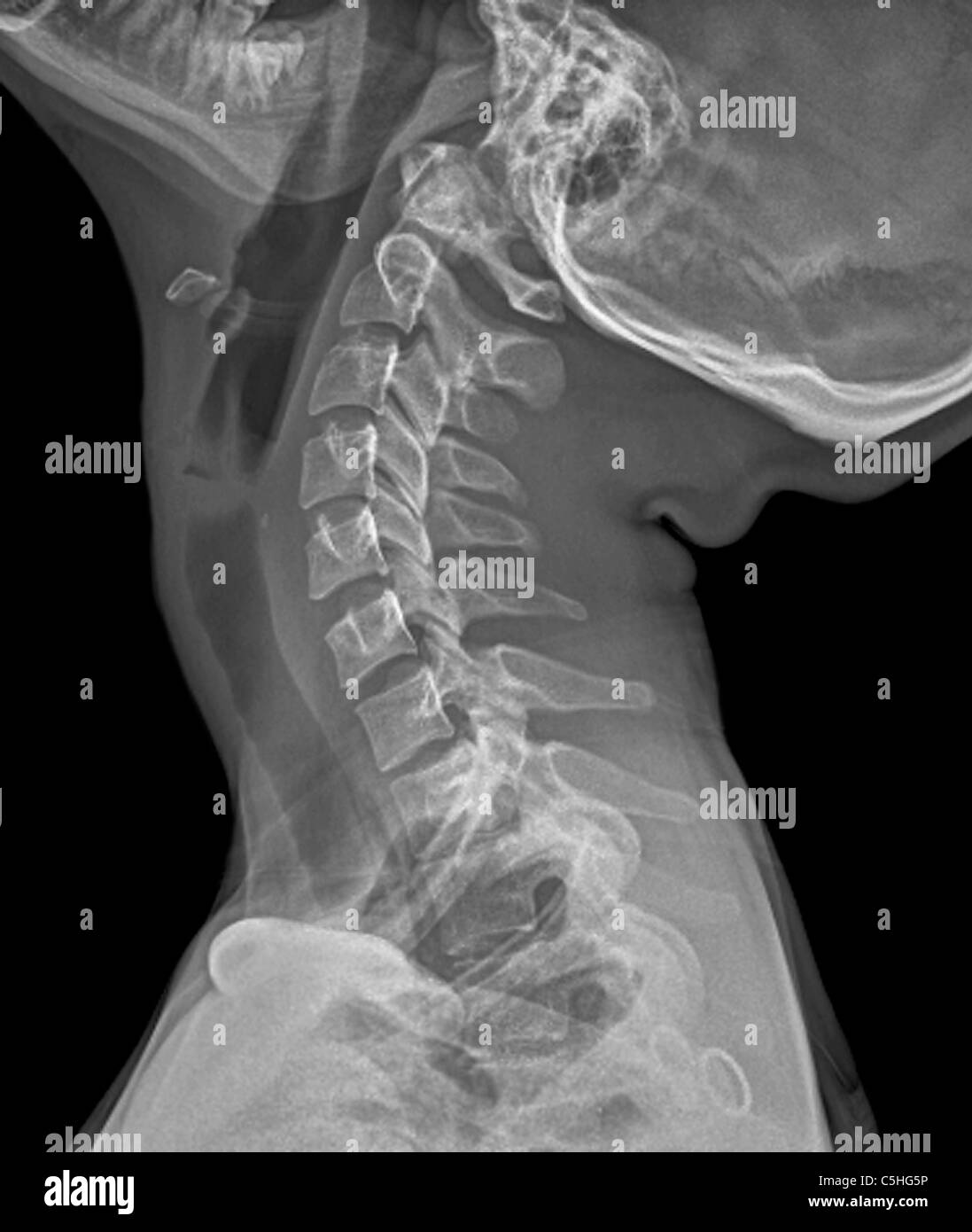 Normal Neck X Ray High Resolution Stock Photography and Images Alamy