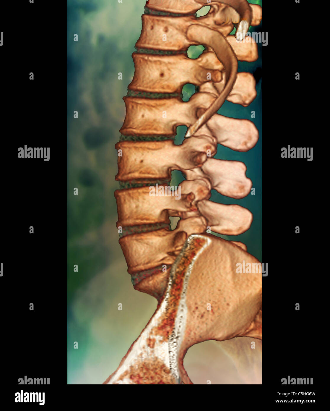 Ct of lumbar spine hi-res stock photography and images - Alamy