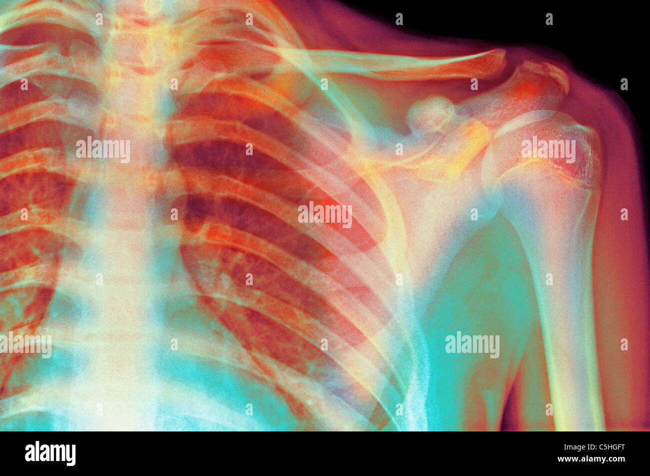 Normal shoulder, Xray Stock Photo Alamy