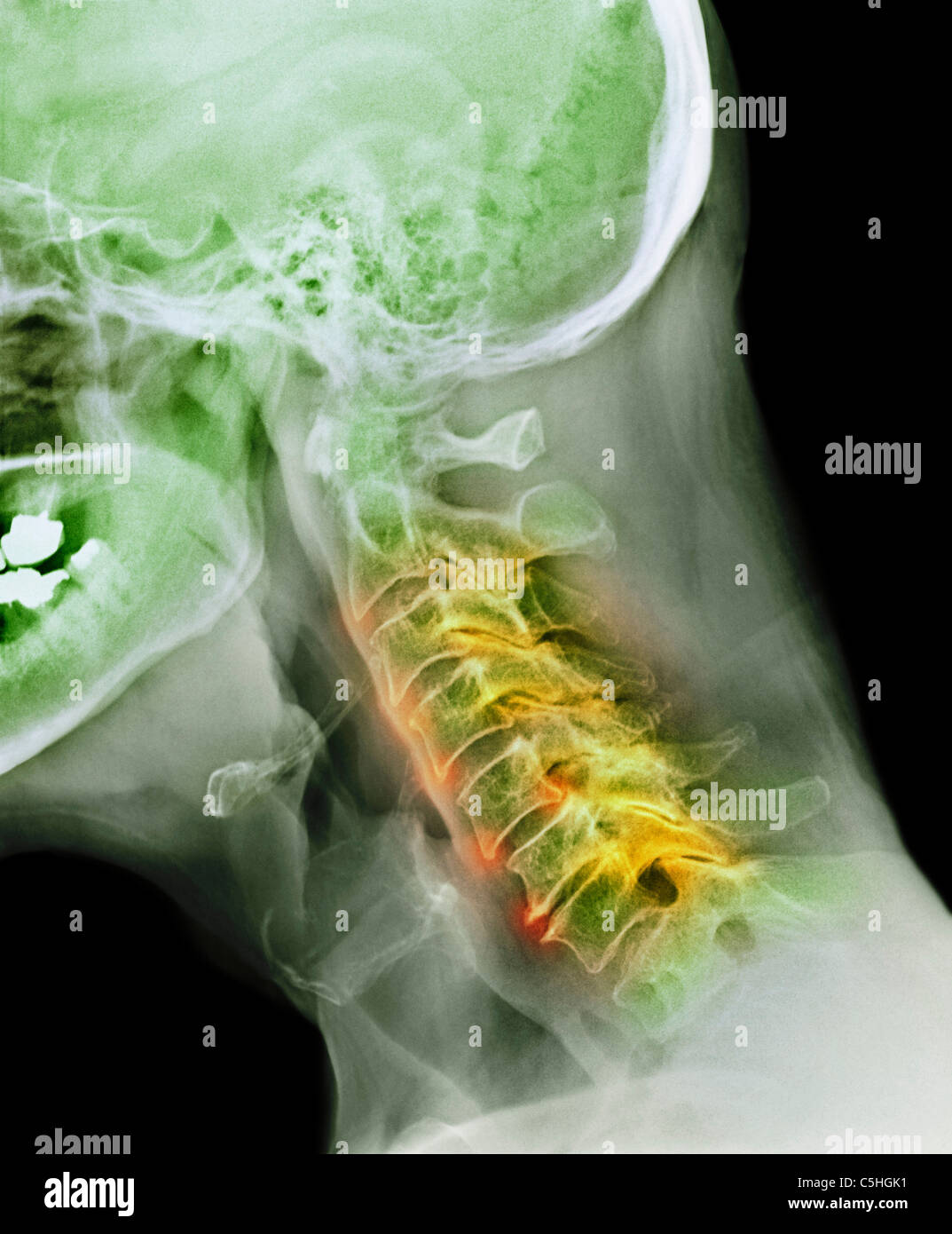Arthritis Of The Neck X Ray Stock Photo Alamy