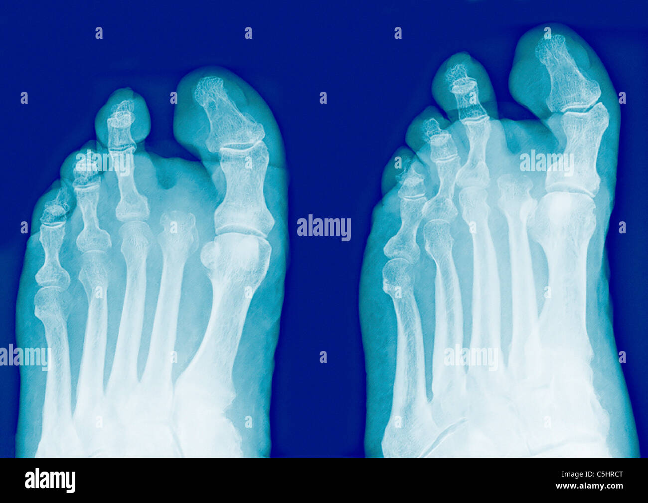 Amputated toe, X-rays Stock Photo