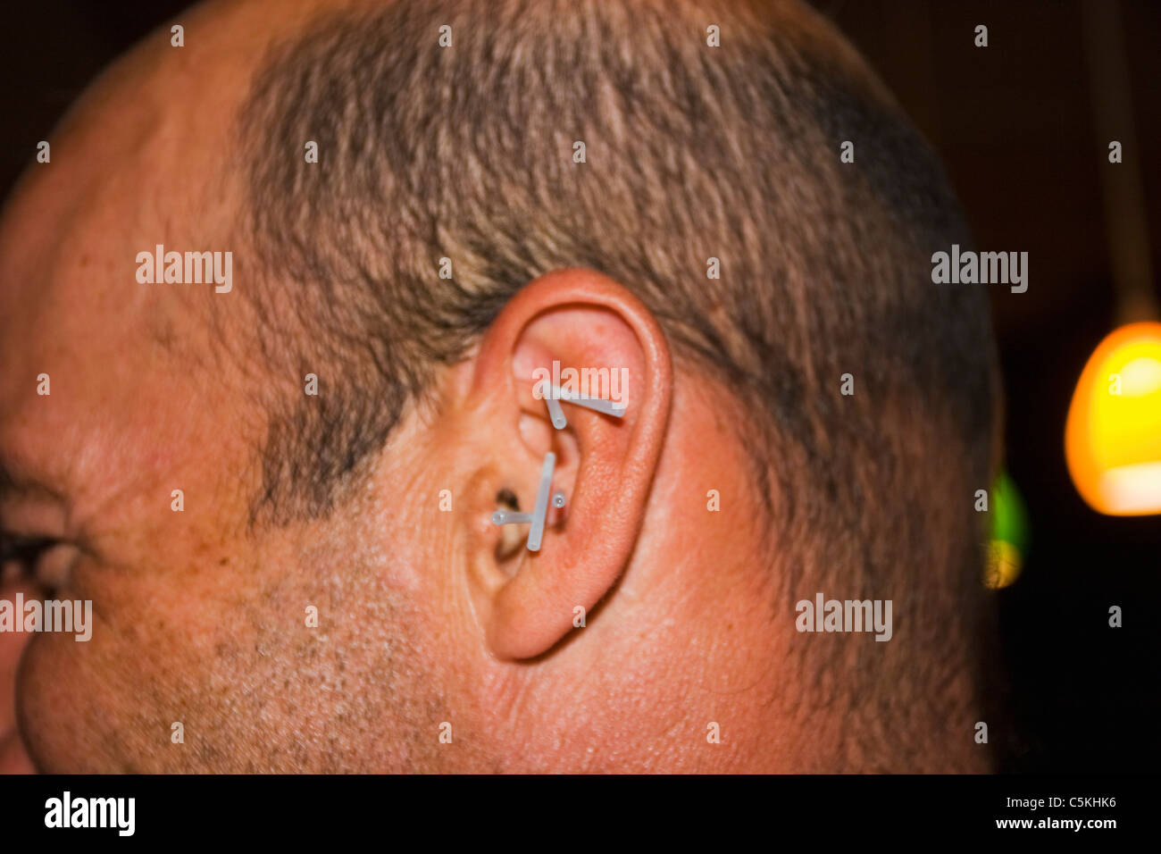Man with acupuncture in ear Stock Photo Alamy