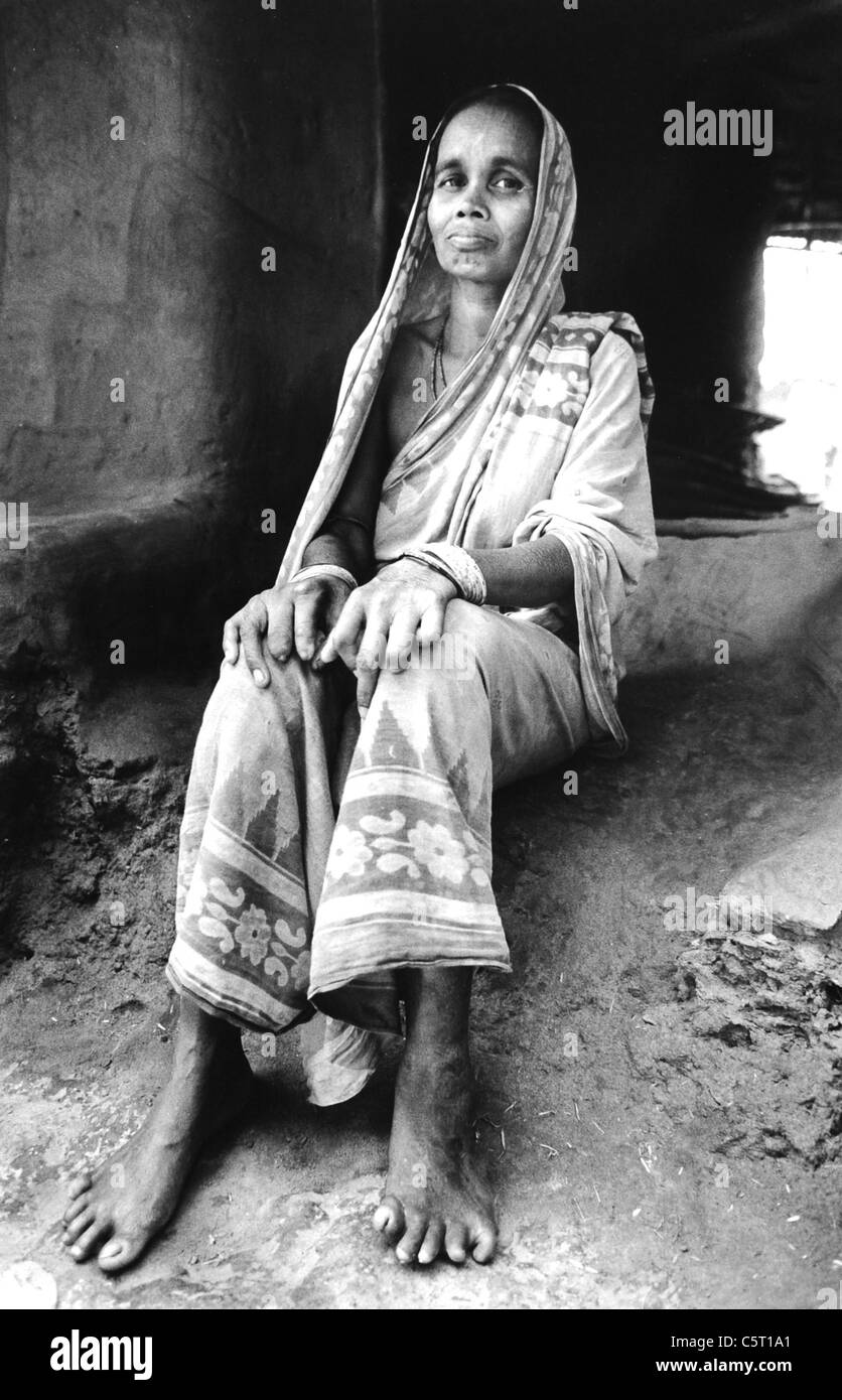45 yr old Khara Barika from the village of Anasura in the Puri district of Orissa in India suffered from leprosy for 18 years Stock Photo