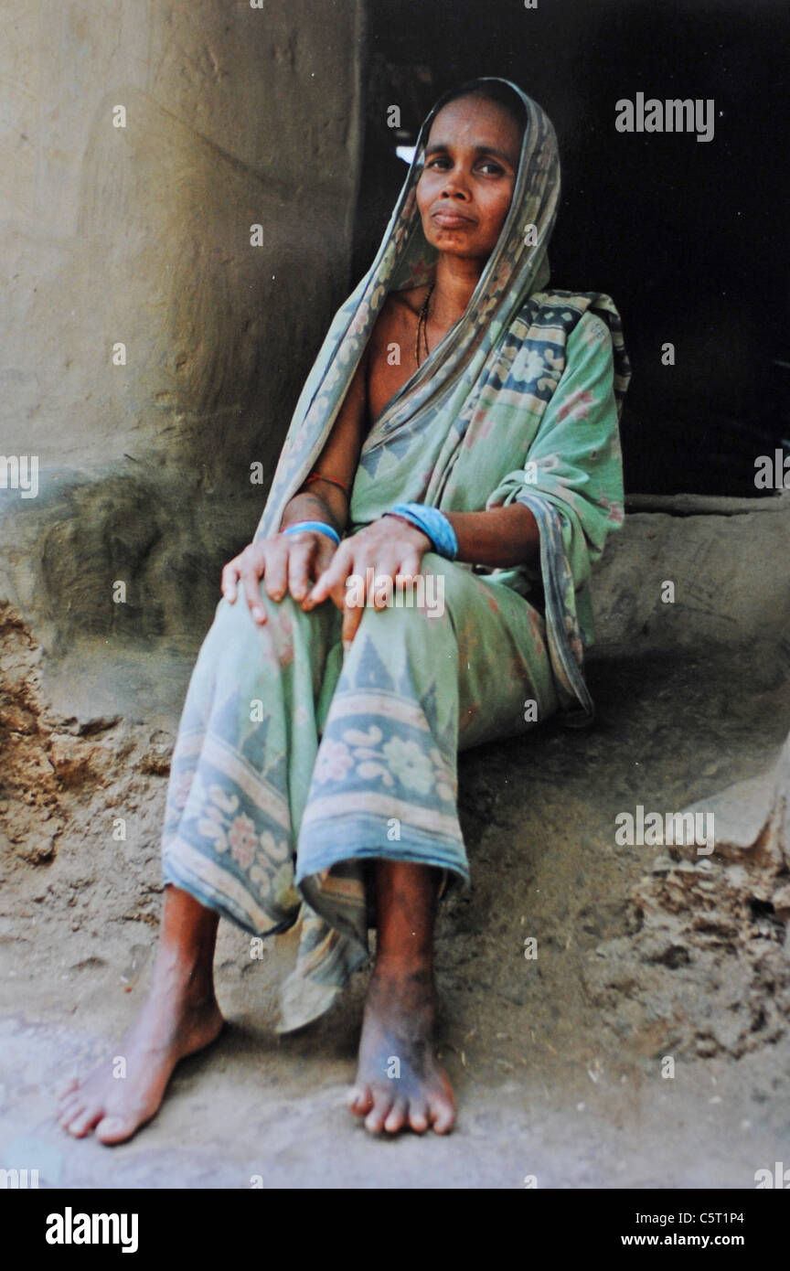 45 yr old Khara Barika from the village of Anasura in the Puri district of Orissa in India suffered from leprosy for 18 years Asia Stock Photo