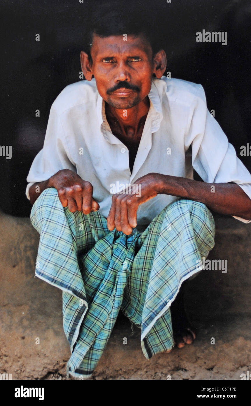 A man from the village of Anasura in the Puri district of Orissa in India suffering from leprosy - photo by Simon Dack Stock Photo