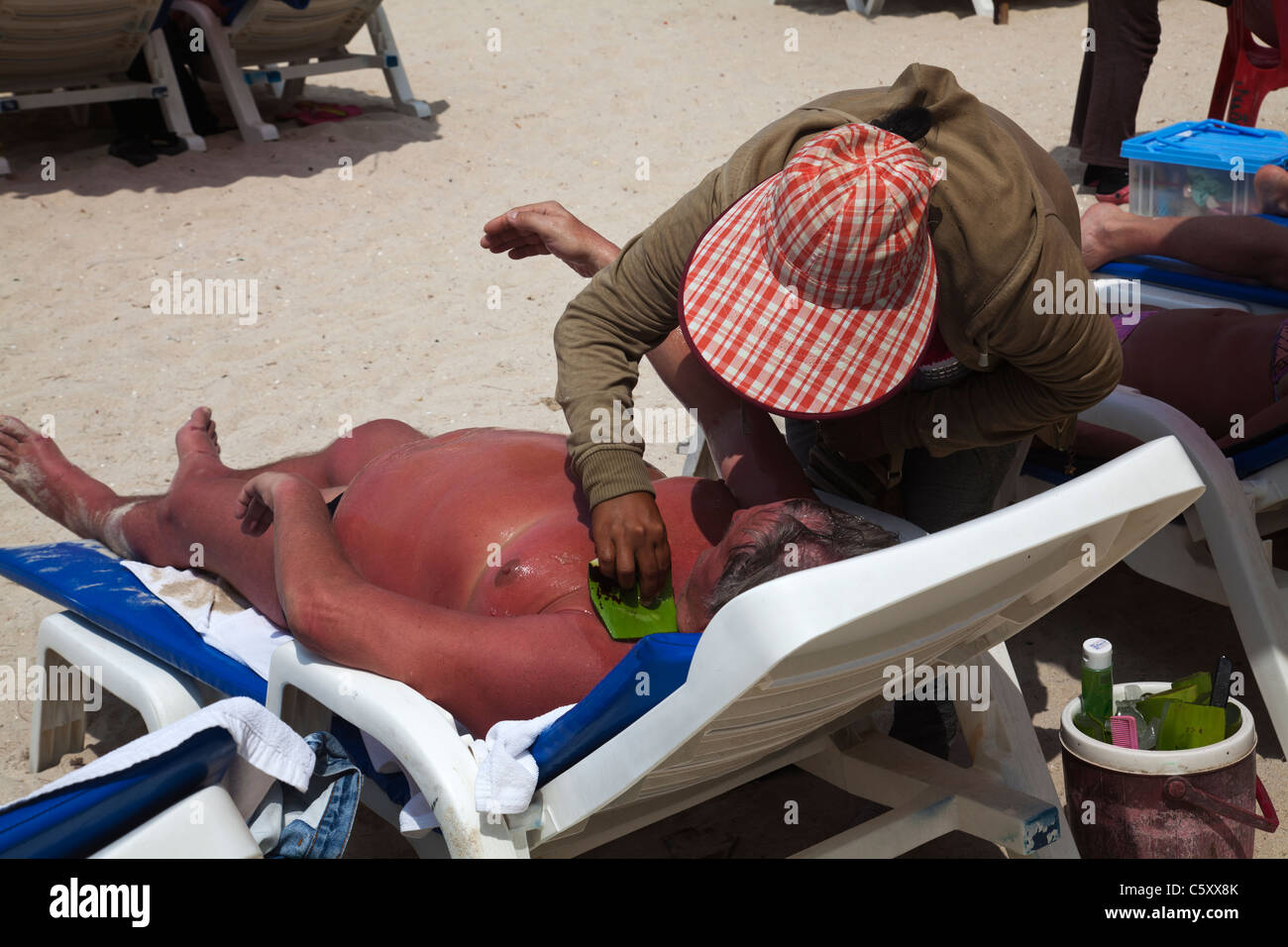 Western tourist being treated fro severe sunburn on the beach Phuket Thailand Stock Photo