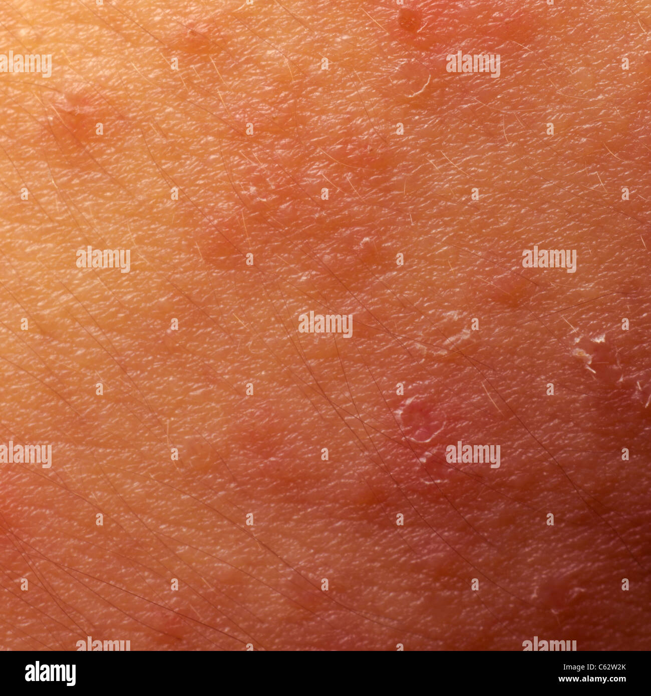 eczema atopic dermatitis symptom skin detail texture Stock Photo