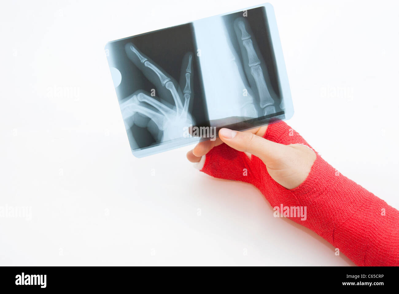 Arm with cast in red plaster with x-ray print Stock Photo