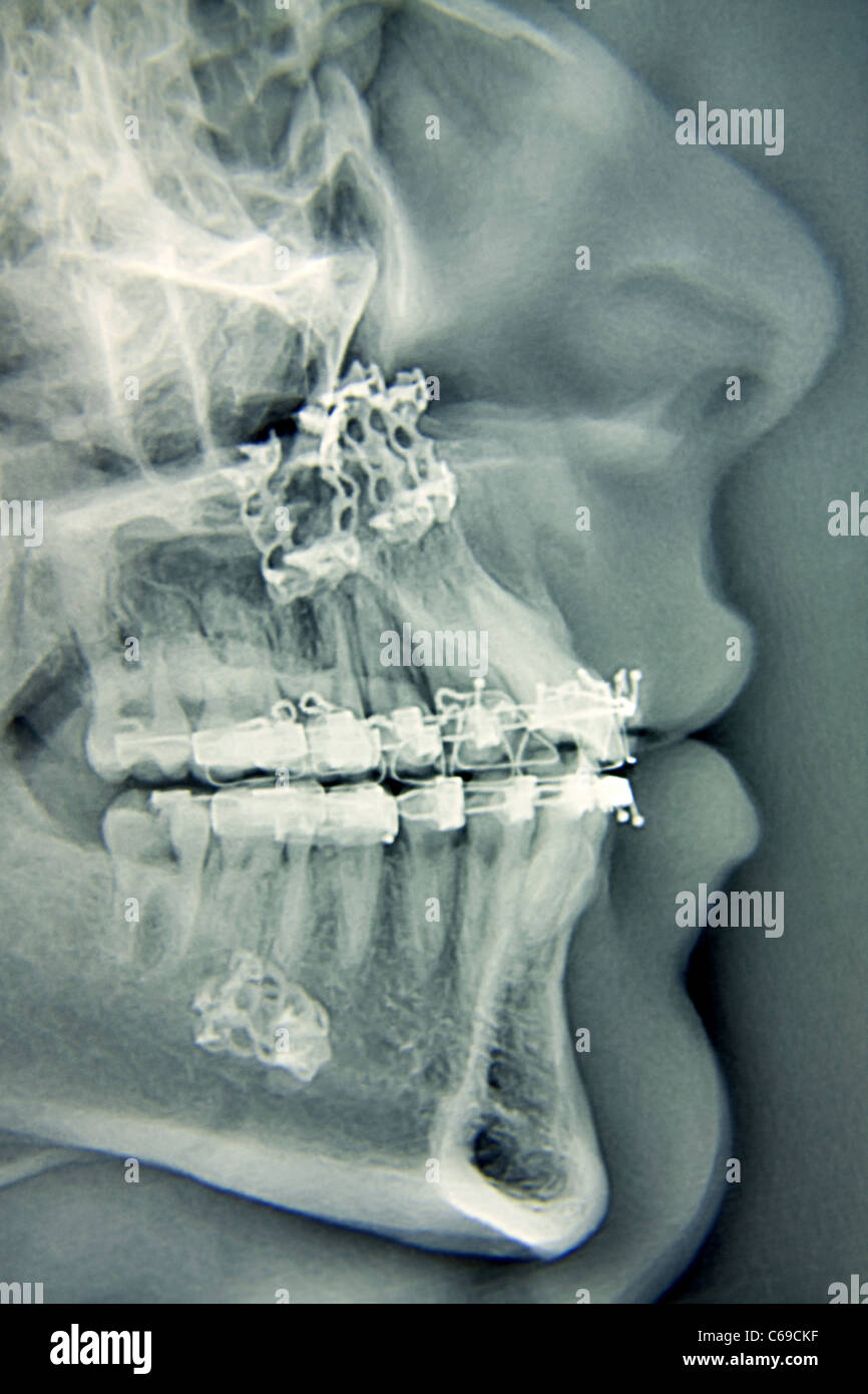Maxilla mandible hi-res stock photography and images - Alamy