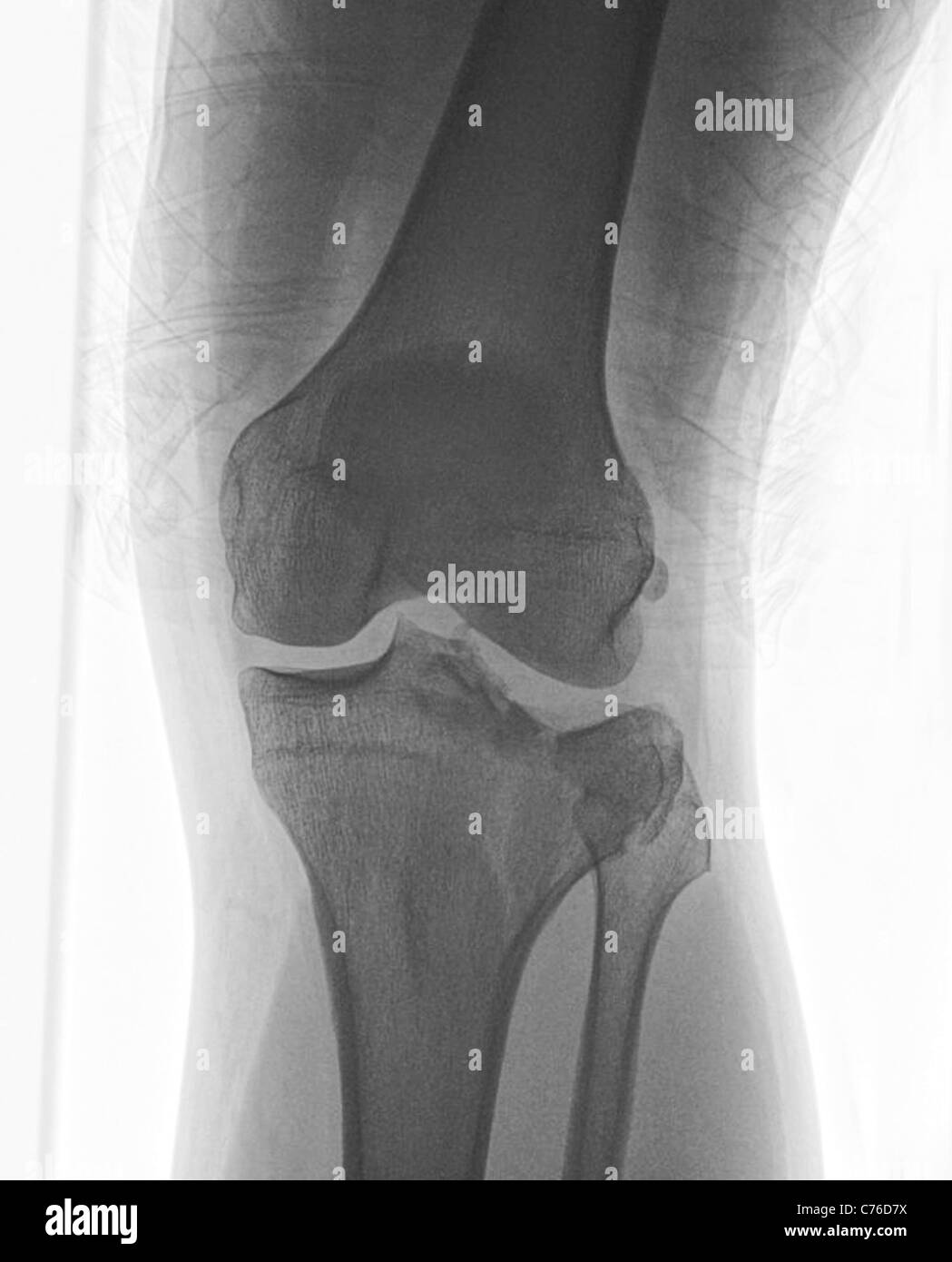 Operation to repair a fractured knee joint (see also x-ray images of plates screws and pins) Stock Photo