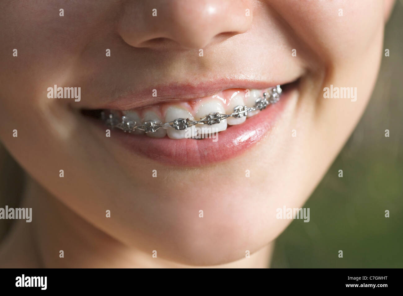 Smile appearance braces teeth hi-res stock photography and images - Alamy