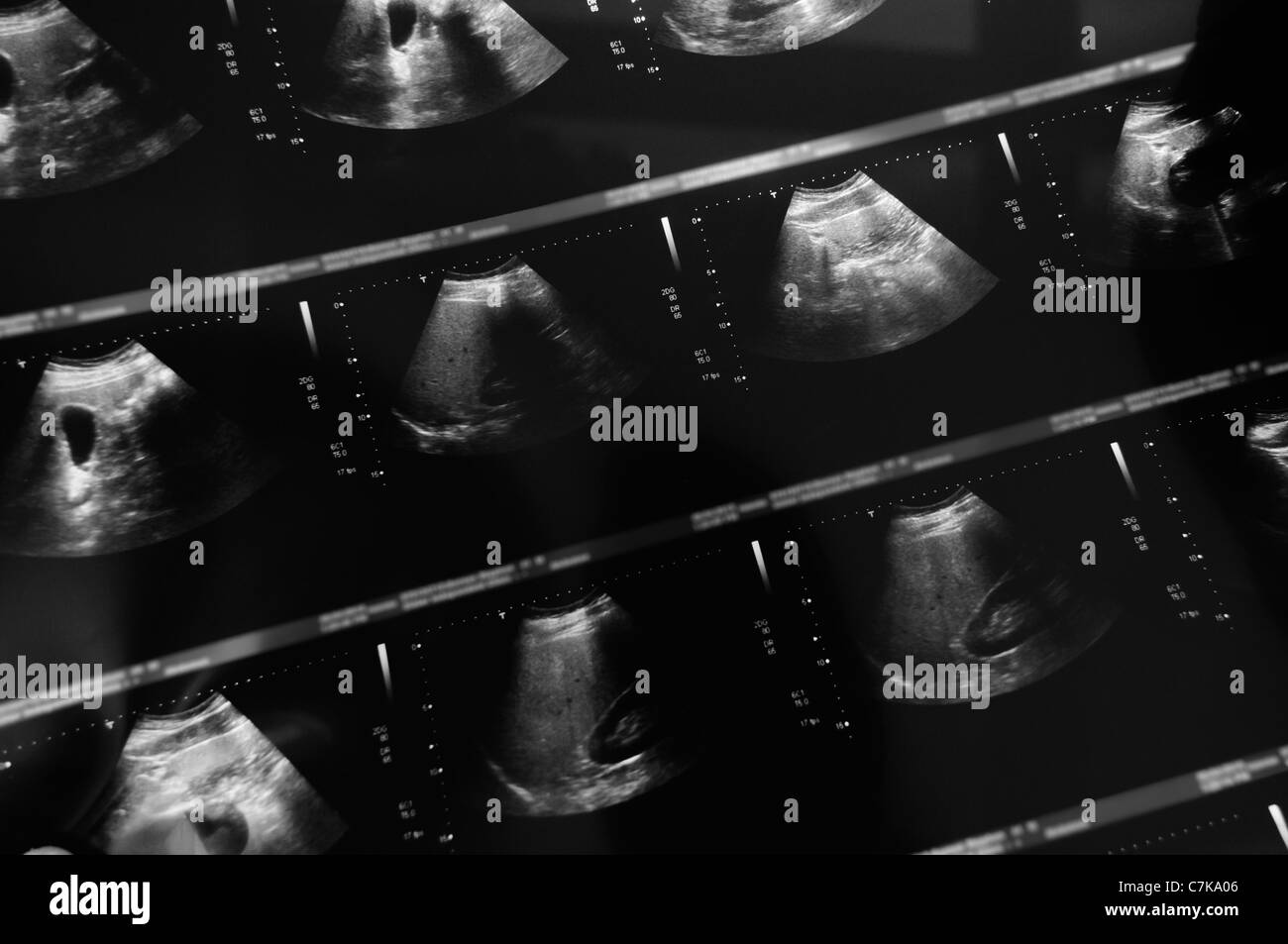 Abdominal CT scan (note: patient details have been blurred out) Stock Photo