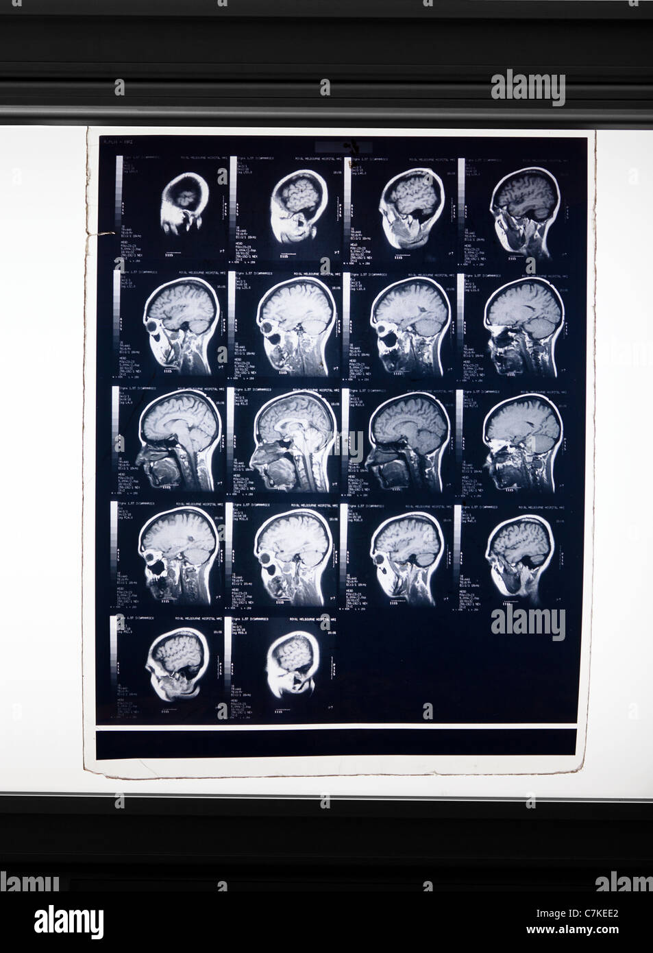 MRI brain scan Stock Photo