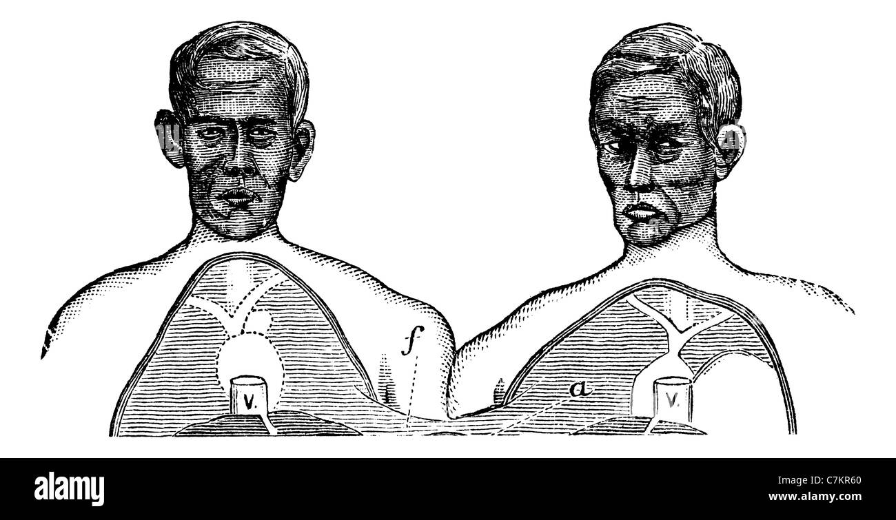 Siamese twins. V. Vena cava. f. Upper limit of the common axis, vintage engraved illustration. Trousset encyclopedia (1886-1891) Stock Photo