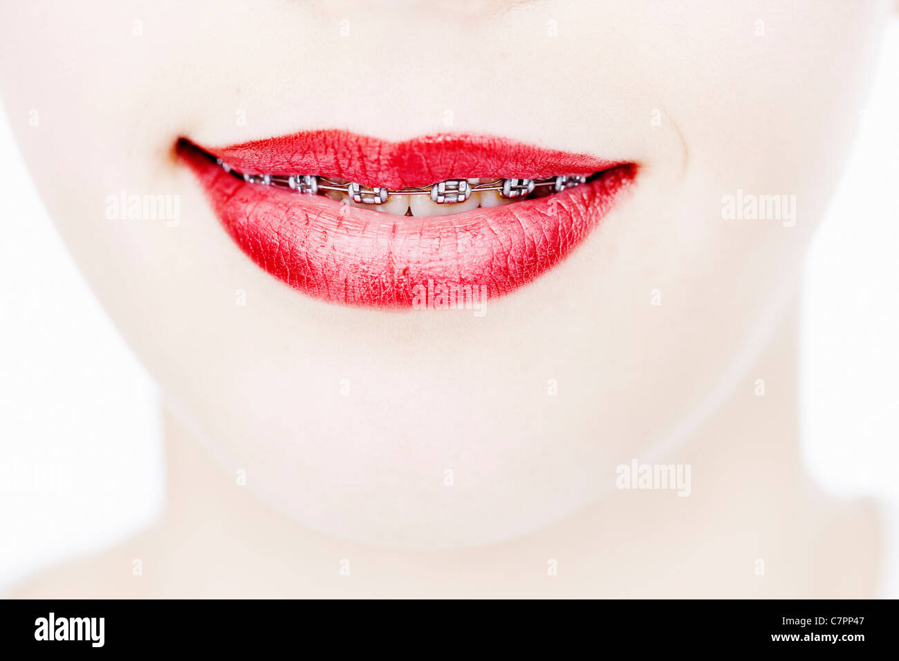 Close up of woman in braces Stock Photo