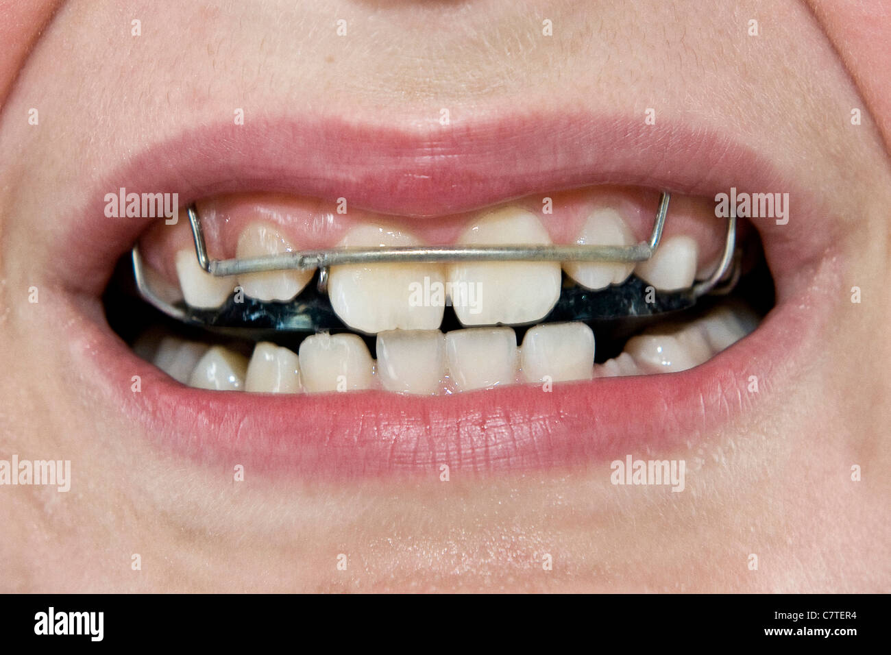 Boy with braces, mouth close up Stock Photo Alamy