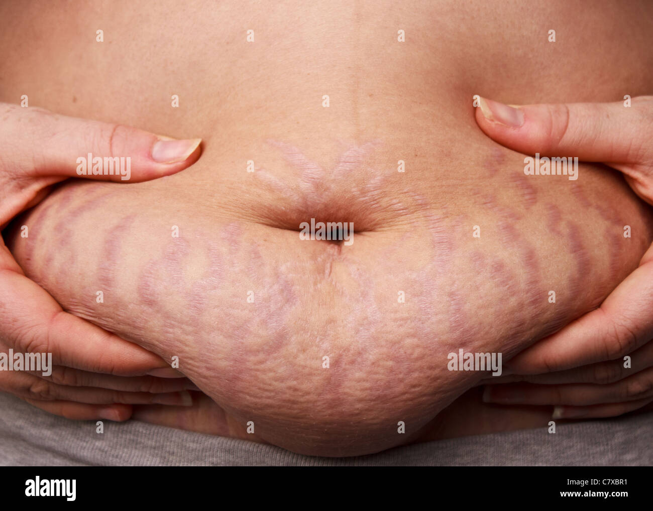 Woman pinching post-pregnancy tummy with stretch marks Stock Photo