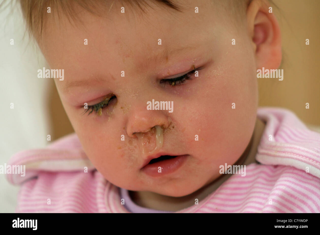 Sick little girl first thing in the morning.  Nasal mucus has dried on her eyebrows while she was asleep overnight Stock Photo