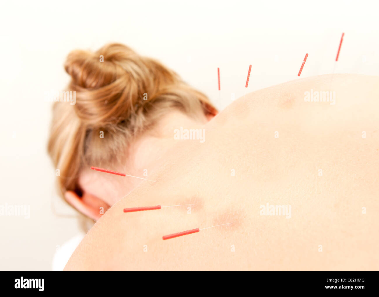 Female acupuncture patient showing good redness at the needle points, a sign of good response to the treatment Stock Photo
