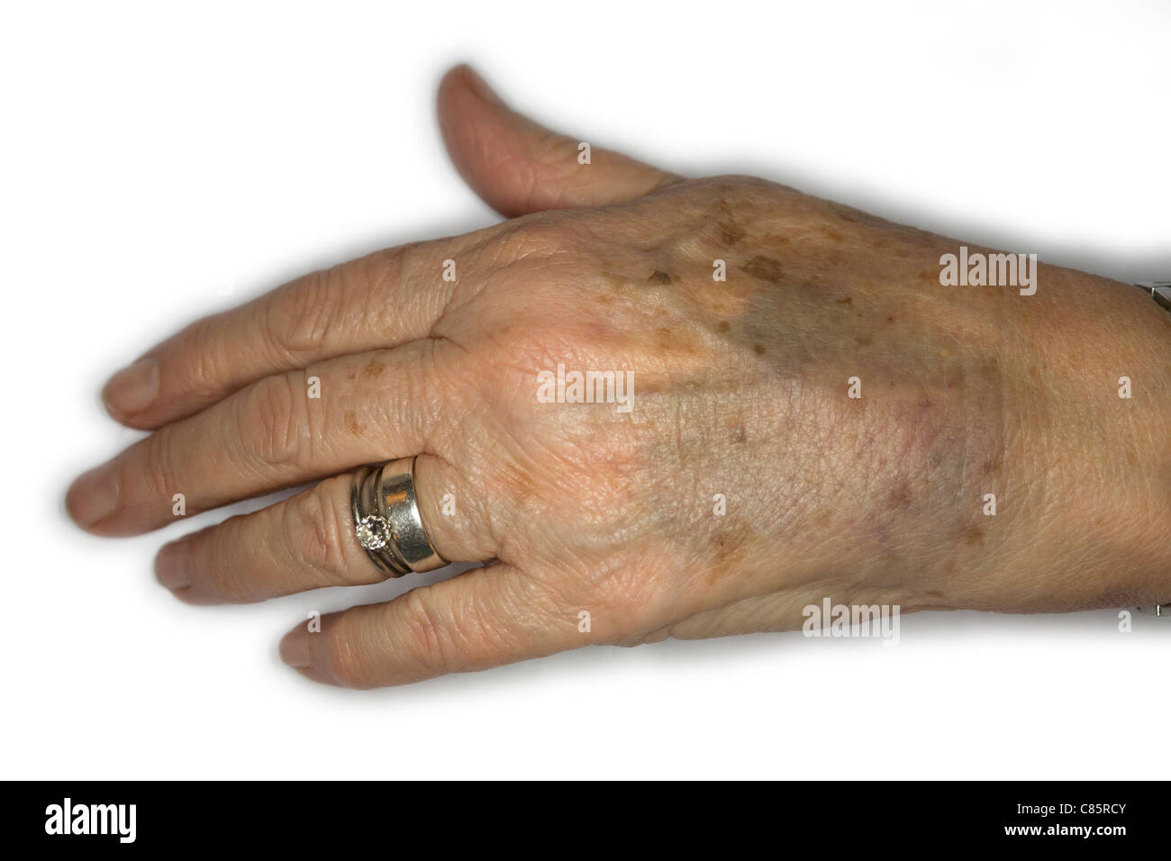 Elderly woman bruised hand hi-res stock photography and images - Alamy