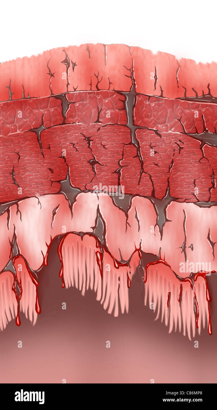 Colon Wall - severe ischemic colitis Stock Photo - Alamy
