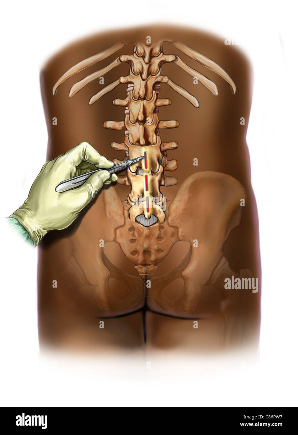 Lumbarization of S1 Stock Photo - Alamy