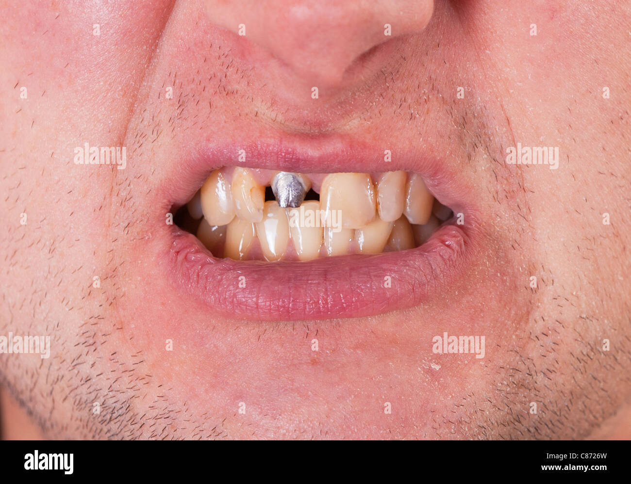 Pin dental hires stock photography and images Alamy
