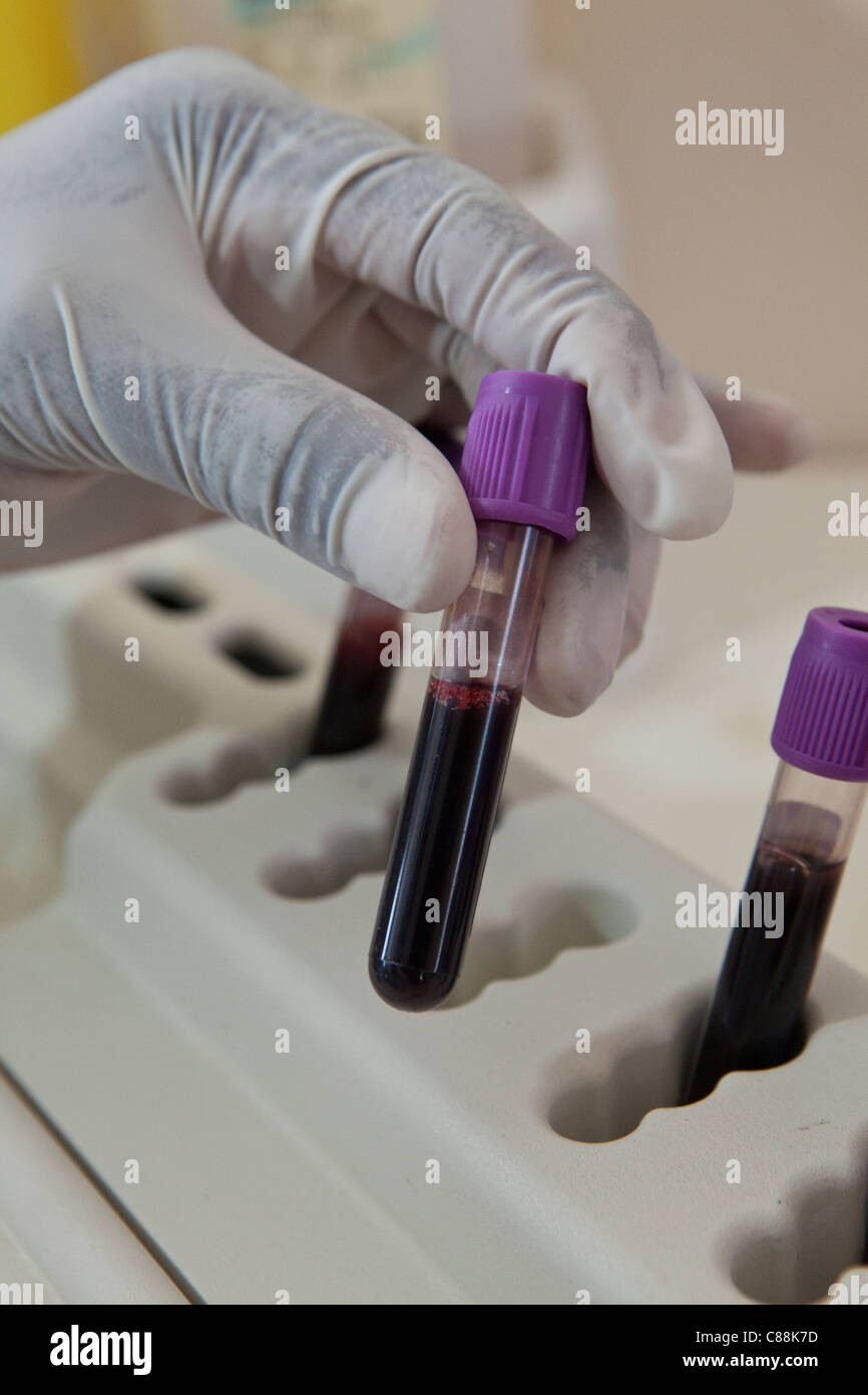 A Laboratory technicians test blood samples of HIV patients at a