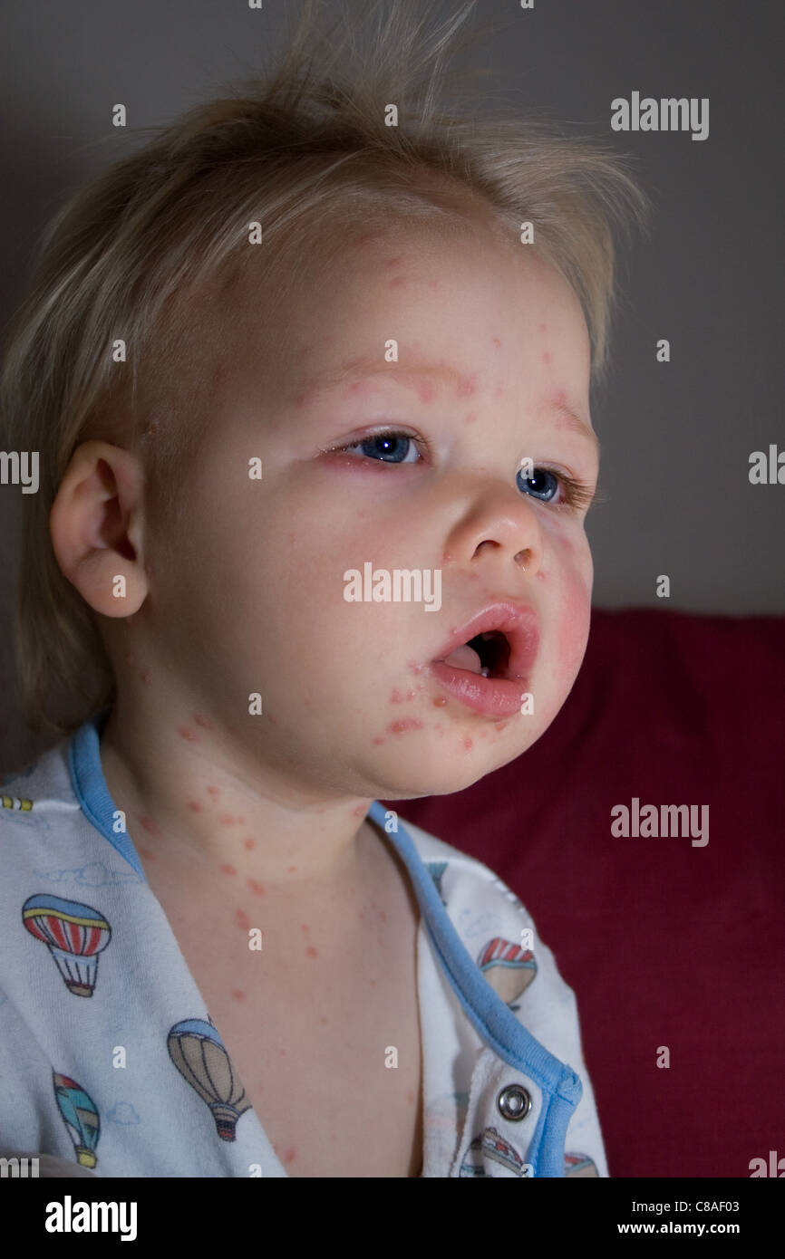 Little baby boy sick with chicken pox and covered in spots Stock Photo