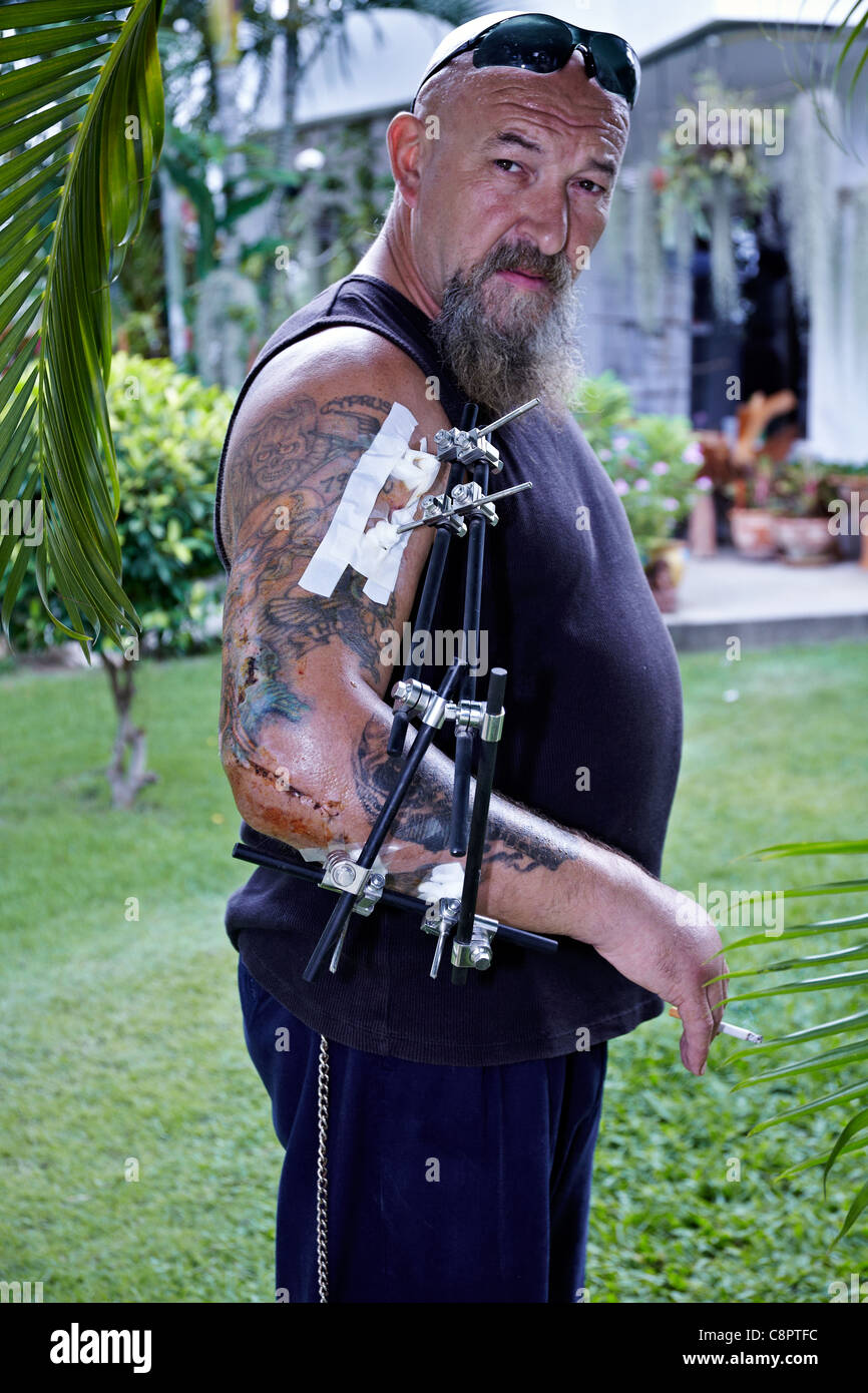 Man with an external fixator application for broken arm damage Stock Photo  - Alamy