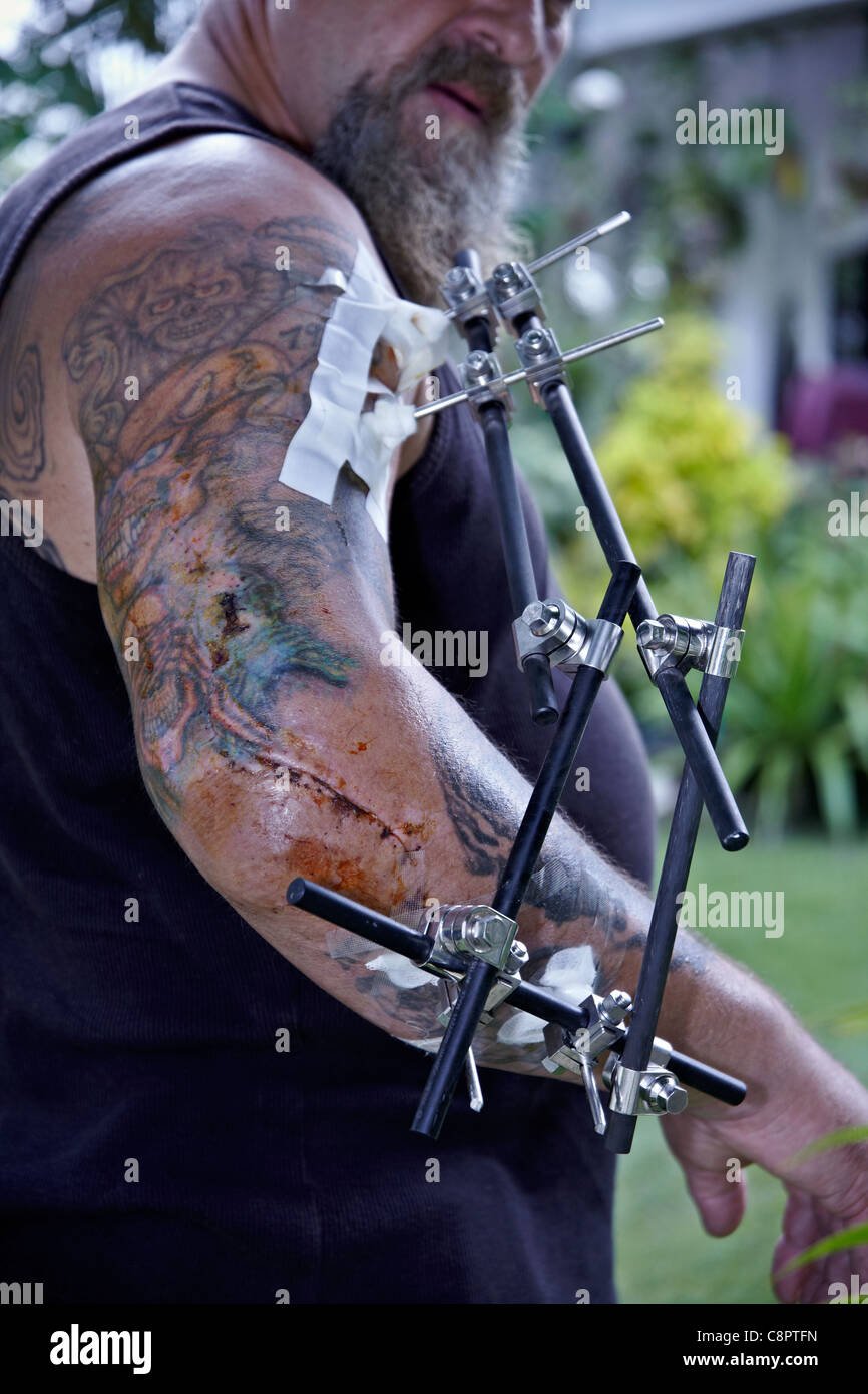 External Fixator High Resolution Stock Photography and Images Alamy