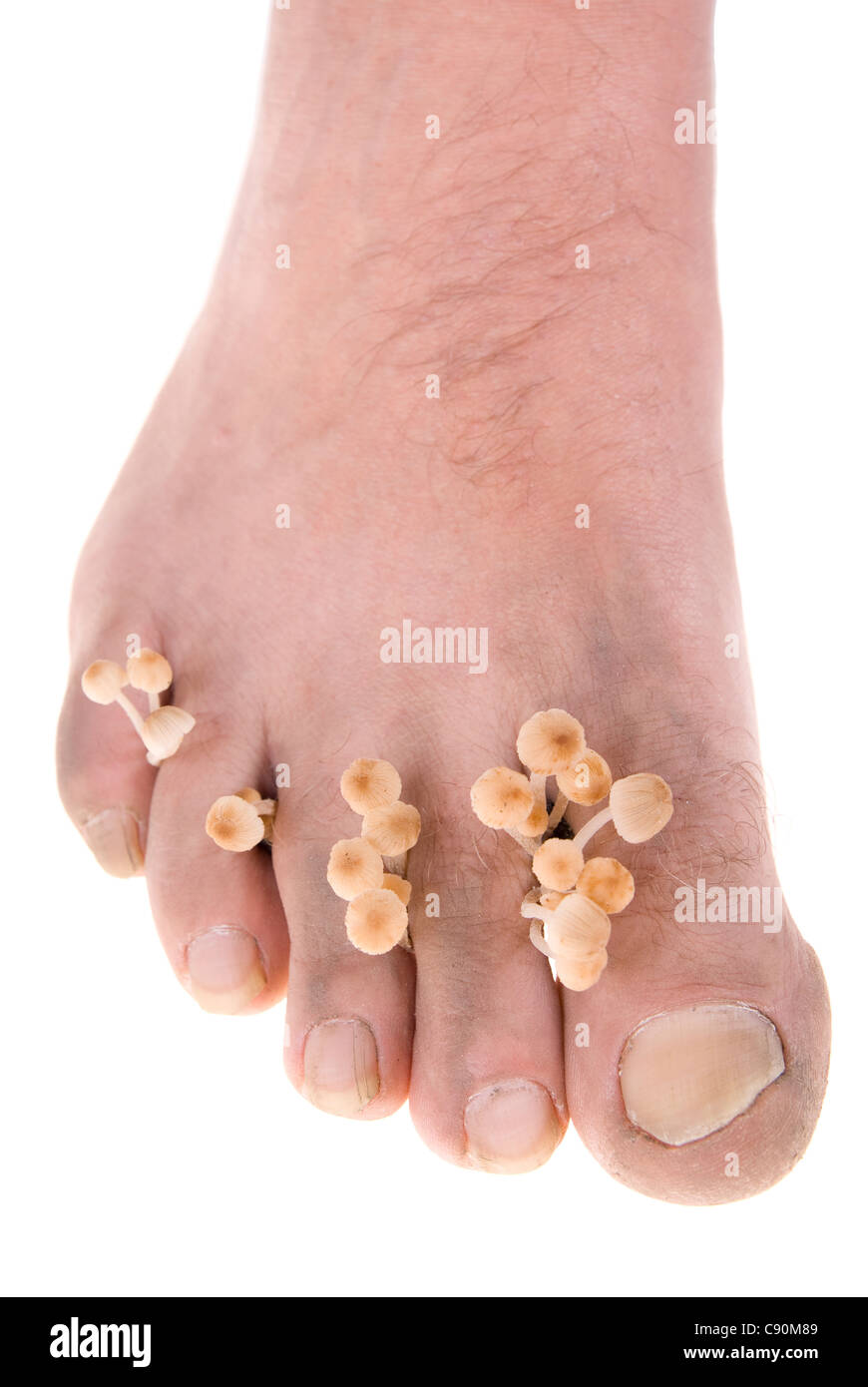 dirty infected foot mycosis on white background Stock Photo - Alamy