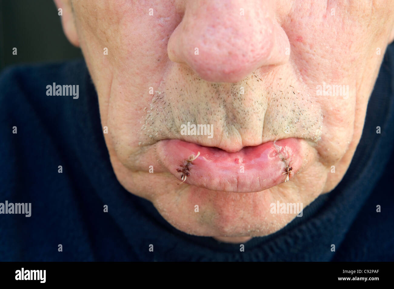 Man With Stitches In Lower Lip After Having Biopsy Stock Photo Alamy man-with-stitches-in-lower-lip-after-having-biopsy-stock-photo-alamy