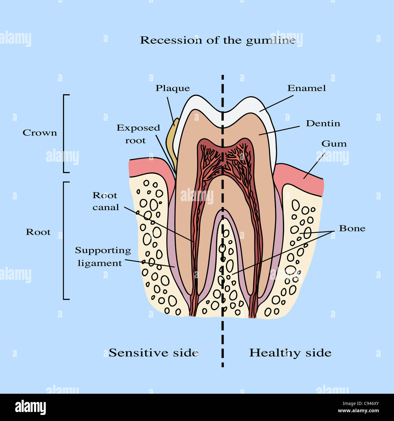 Human tooth anatomy illustration - recession of the gumline Stock Photo