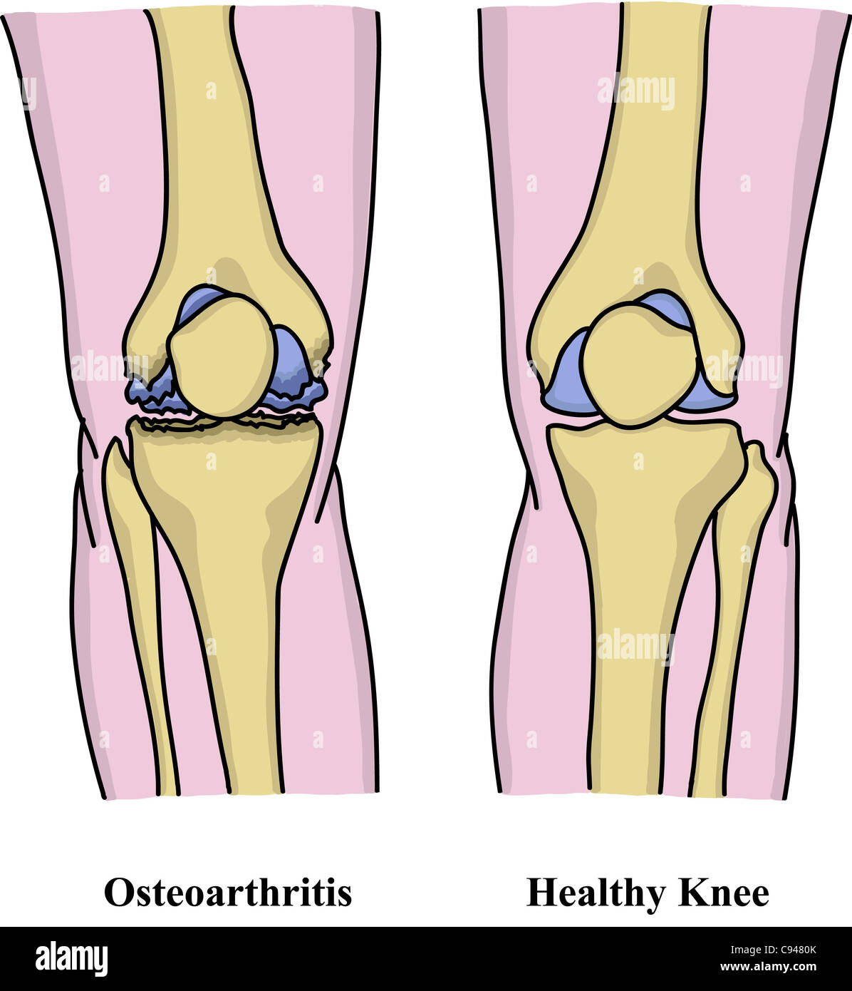 Osteoarthritis illustration Stock Photo