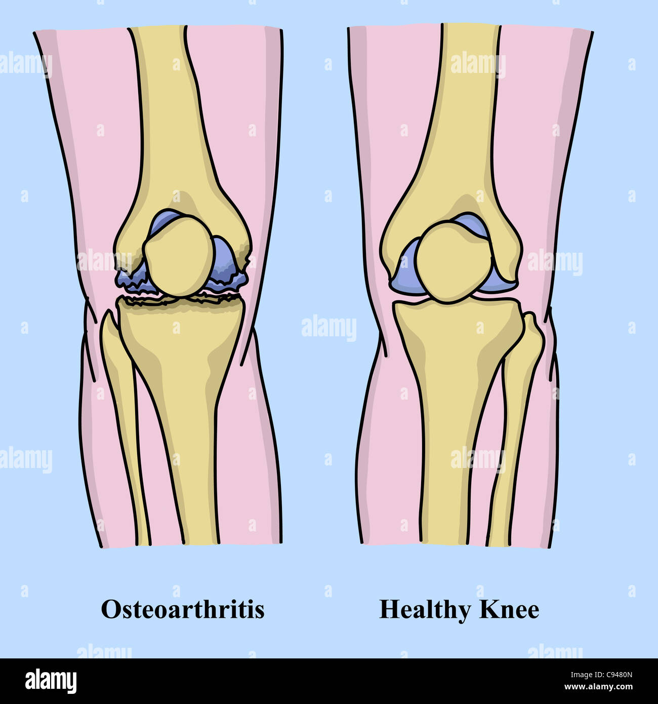 Osteoarthritis illustration Stock Photo