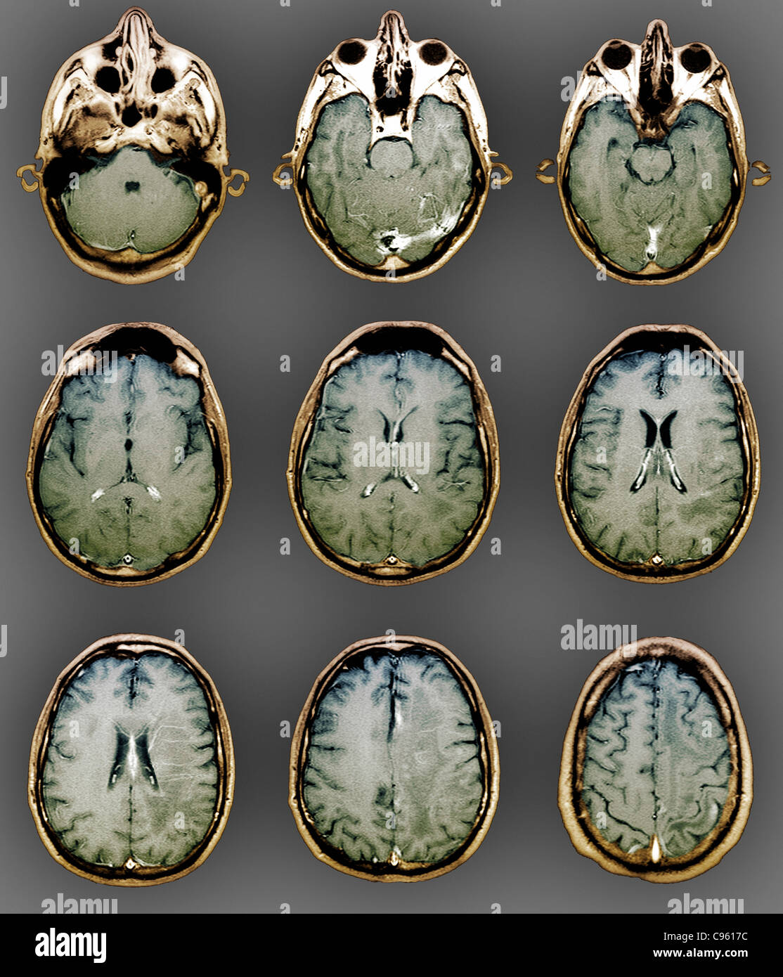Normal brain, MRI scans Stock Photo